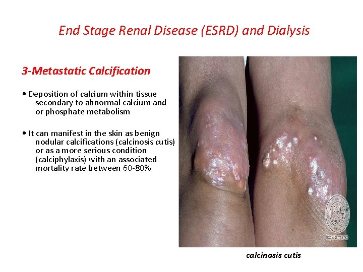 End Stage Renal Disease (ESRD) and Dialysis 3 -Metastatic Calcification • Deposition of calcium