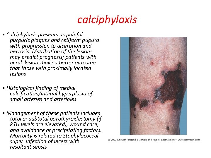 calciphylaxis • Calciphylaxis presents as painful purpuric plaques and retiform pupura with progression to