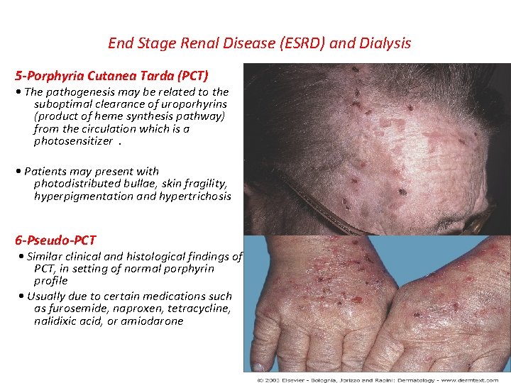 End Stage Renal Disease (ESRD) and Dialysis 5 -Porphyria Cutanea Tarda (PCT) • The