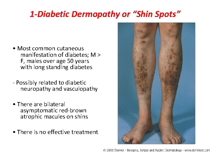 1 -Diabetic Dermopathy or “Shin Spots” • Most common cutaneous manifestation of diabetes; M