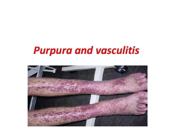 Purpura and vasculitis 