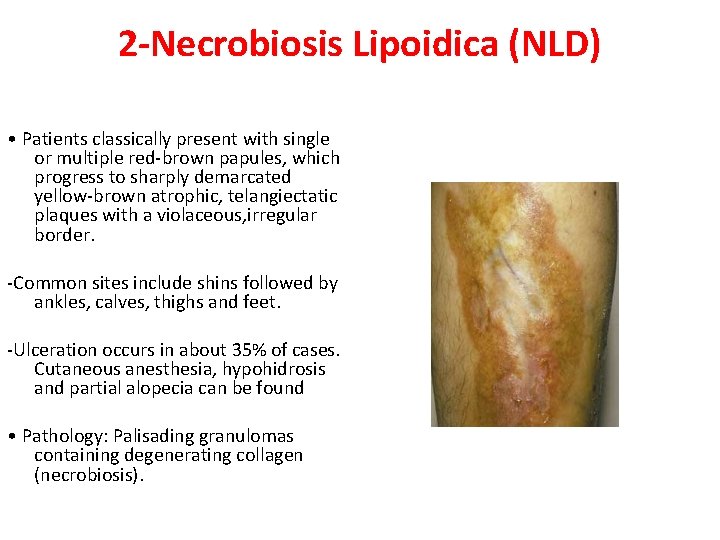 2 -Necrobiosis Lipoidica (NLD) • Patients classically present with single or multiple red-brown papules,