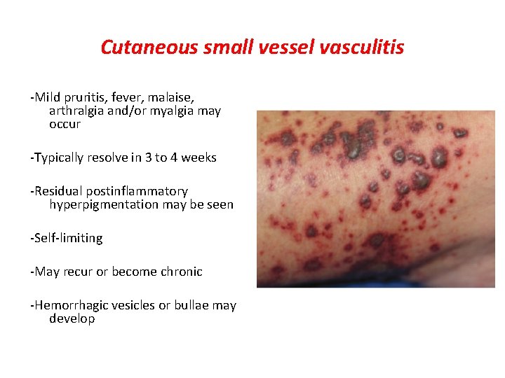 Cutaneous small vessel vasculitis -Mild pruritis, fever, malaise, arthralgia and/or myalgia may occur -Typically