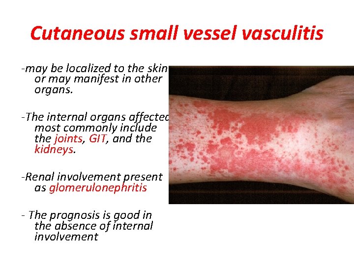 Cutaneous small vessel vasculitis -may be localized to the skin or may manifest in