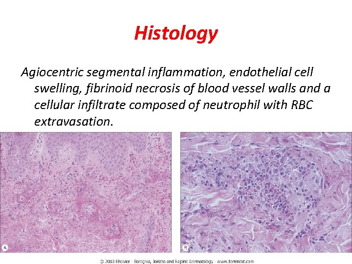 Histology Agiocentric segmental inflammation, endothelial cell swelling, fibrinoid necrosis of blood vessel walls and
