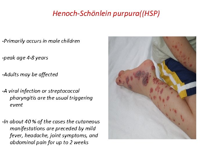 Henoch-Schönlein purpura((HSP) -Primarily occurs in male children -peak age 4 -8 years -Adults may