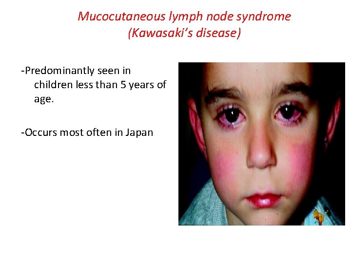 Mucocutaneous lymph node syndrome (Kawasaki’s disease) -Predominantly seen in children less than 5 years