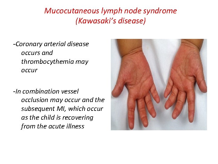 Mucocutaneous lymph node syndrome (Kawasaki’s disease) -Coronary arterial disease occurs and thrombocythemia may occur