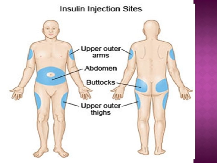 Sites of injecting insulin 