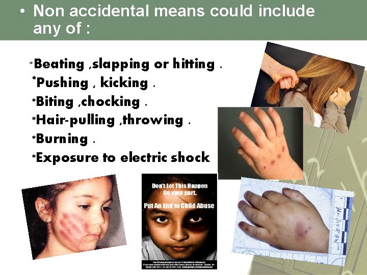  • Non accidental means could include any of : *Beating , slapping or