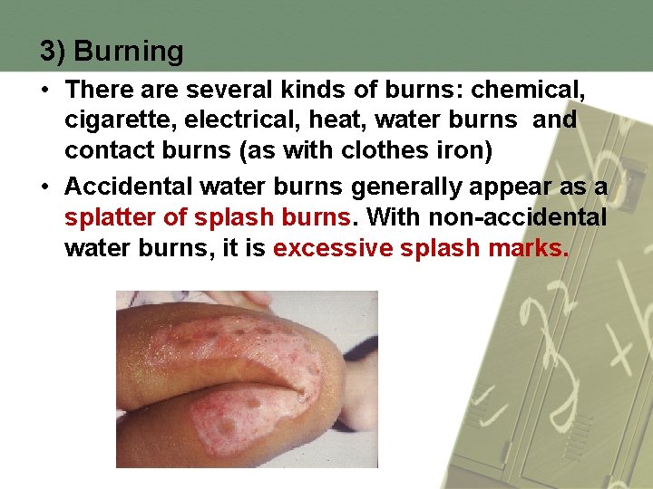 3) Burning • There are several kinds of burns: chemical, cigarette, electrical, heat, water