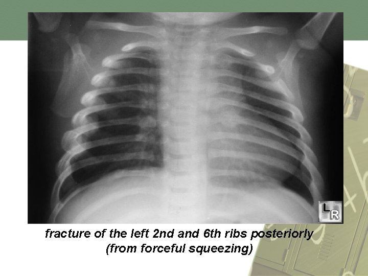 fracture of the left 2 nd and 6 th ribs posteriorly (from forceful squeezing)
