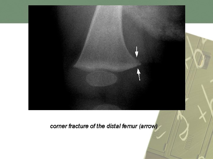 corner fracture of the distal femur (arrow) 