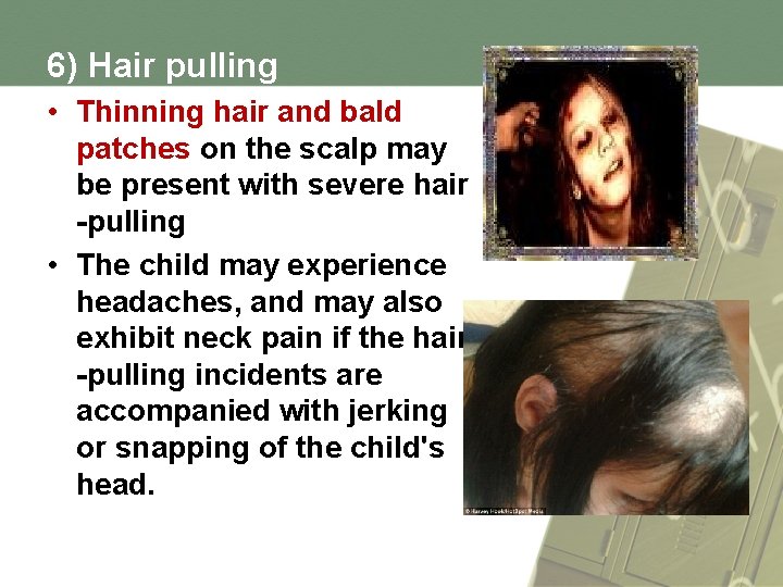6) Hair pulling • Thinning hair and bald patches on the scalp may be