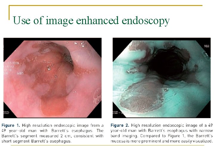 Use of image enhanced endoscopy 