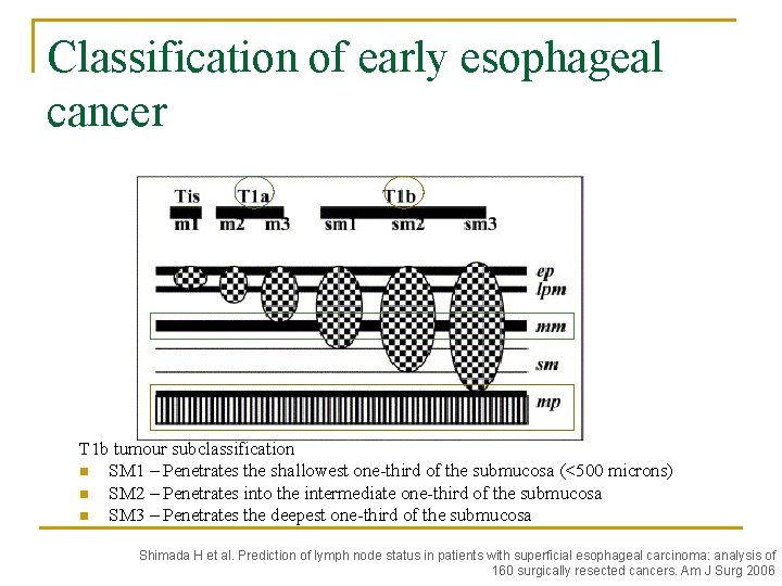 Classification of early esophageal cancer T 1 b tumour subclassification n SM 1 –