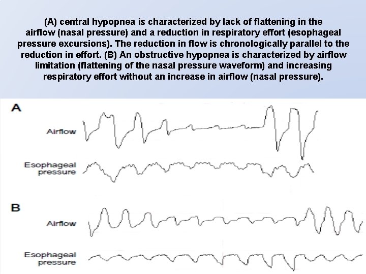 (A) central hypopnea is characterized by lack of flattening in the airflow (nasal pressure)