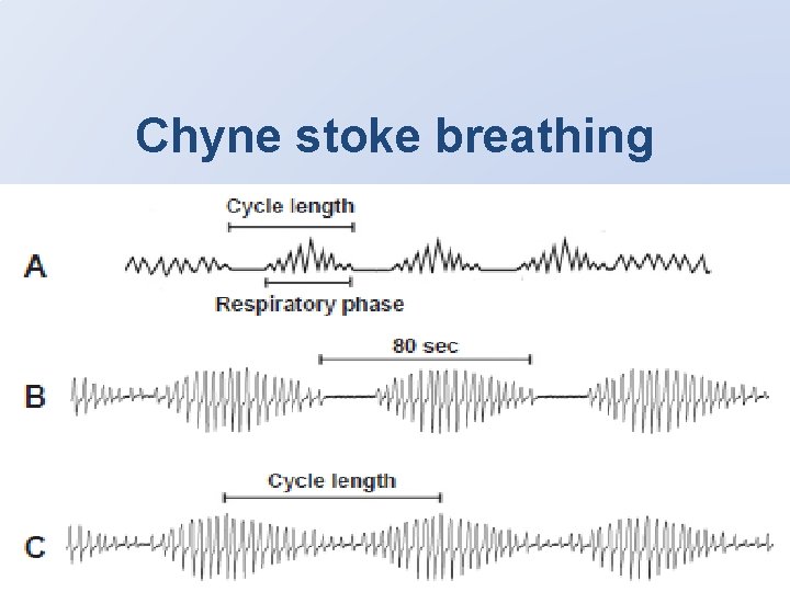 Chyne stoke breathing 