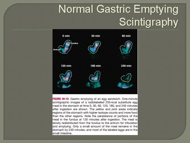 Normal Gastric Emptying Scintigraphy 