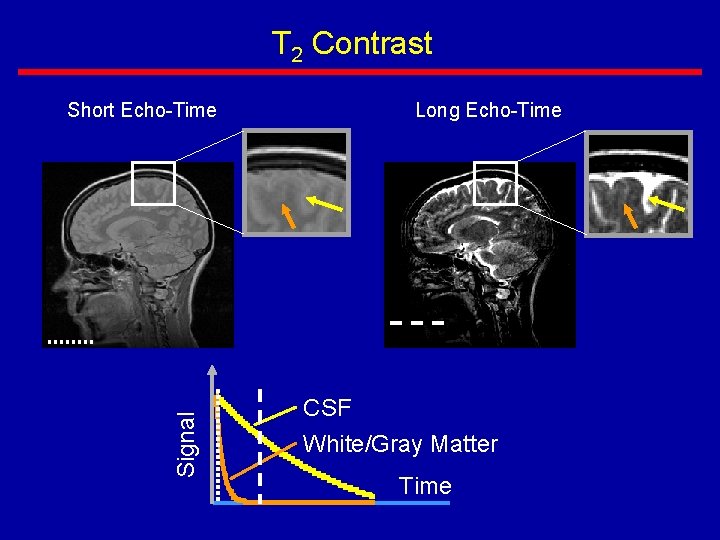 T 2 Contrast Signal Short Echo-Time Long Echo-Time CSF White/Gray Matter Time 