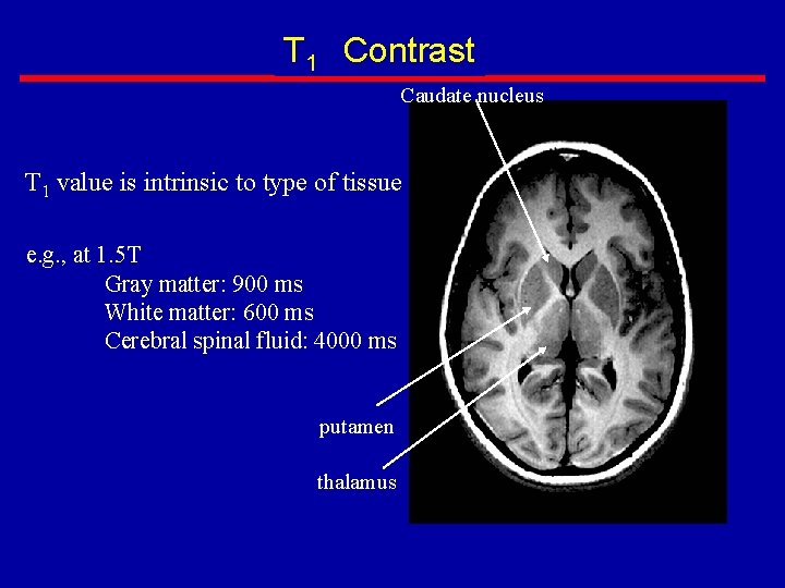 T 1 Contrast Caudate nucleus T 1 value is intrinsic to type of tissue