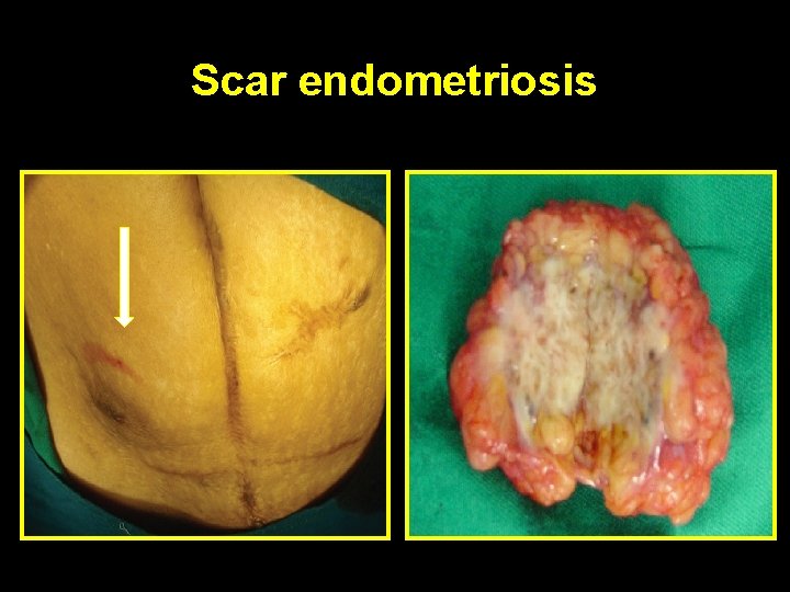 Scar endometriosis 
