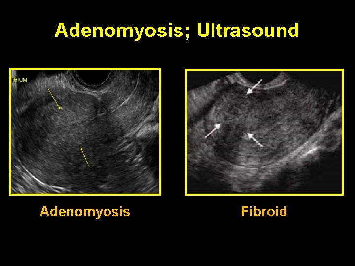 Adenomyosis; Ultrasound Adenomyosis Fibroid 