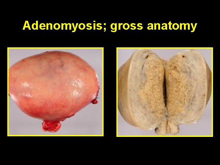 Adenomyosis; gross anatomy 
