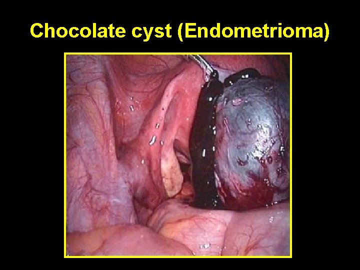 Chocolate cyst (Endometrioma) 