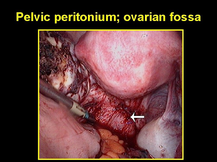 Pelvic peritonium; ovarian fossa 