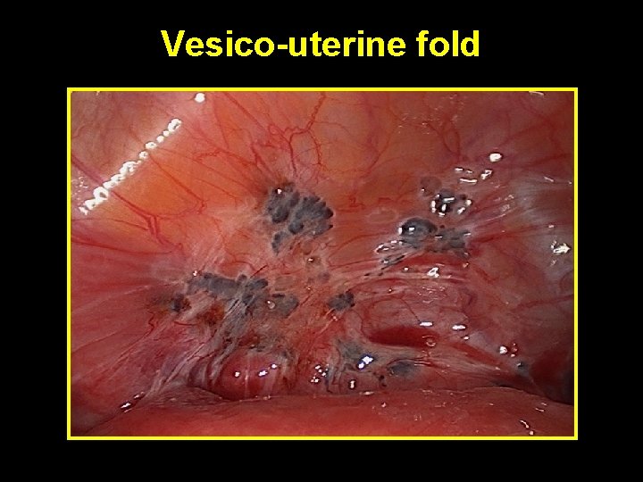 Vesico-uterine fold 