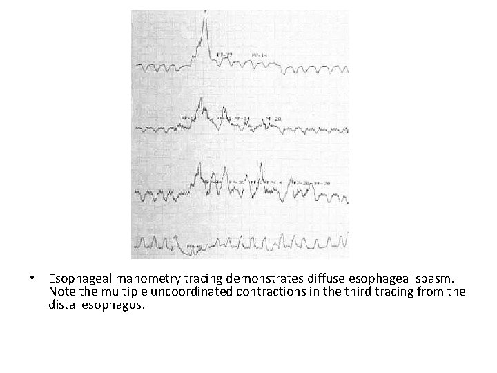  • Esophageal manometry tracing demonstrates diffuse esophageal spasm. Note the multiple uncoordinated contractions