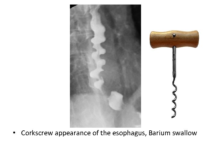  • Corkscrew appearance of the esophagus, Barium swallow 