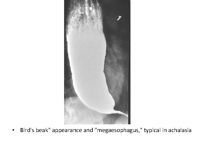  • Bird's beak" appearance and "megaesophagus, " typical in achalasia 