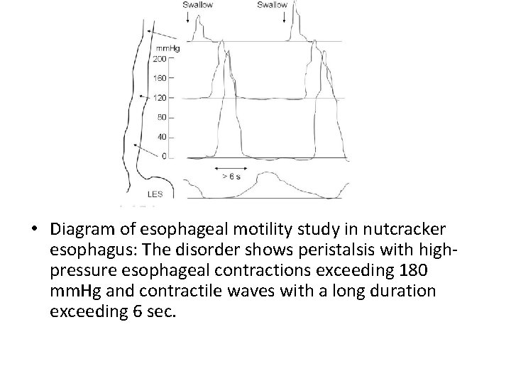  • Diagram of esophageal motility study in nutcracker esophagus: The disorder shows peristalsis