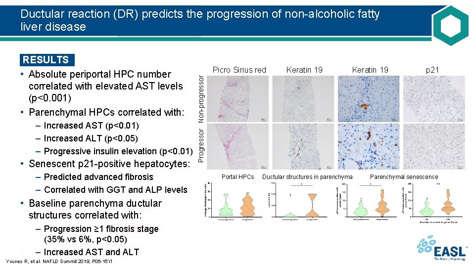 Ductular reaction (DR) predicts the progression of non-alcoholic fatty liver disease – Increased AST