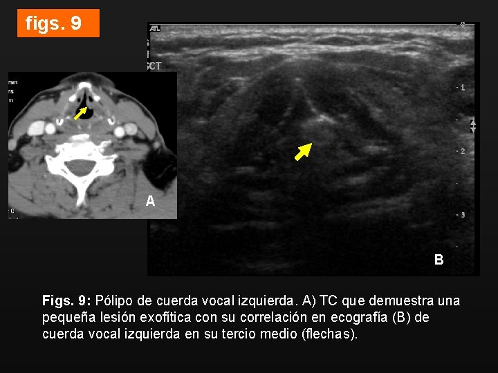 figs. 9 Polipo cvi med A B Figs. 9: Pólipo de cuerda vocal izquierda.