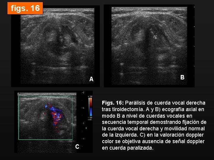figs. 16 A C B Figs. 16: Parálisis de cuerda vocal derecha tras tiroidectomía.