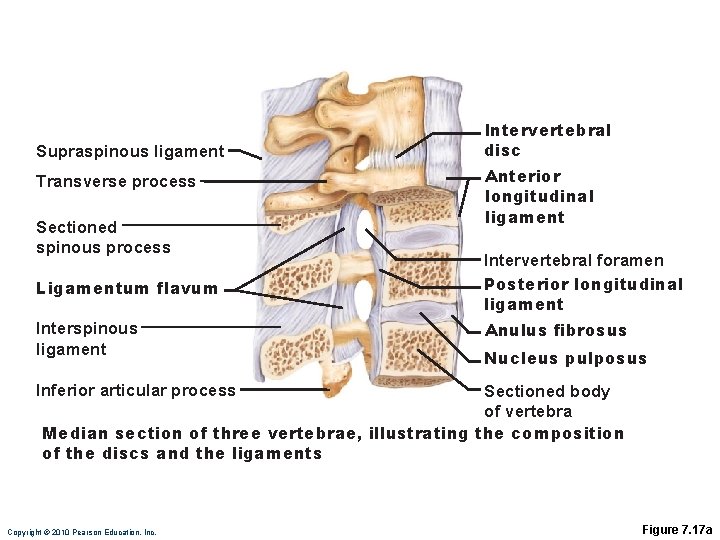 Supraspinous ligament Transverse process Sectioned spinous process Ligamentum flavum Interspinous ligament Intervertebral disc Anterior