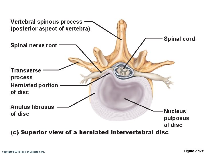 Vertebral spinous process (posterior aspect of vertebra) Spinal cord Spinal nerve root Transverse process