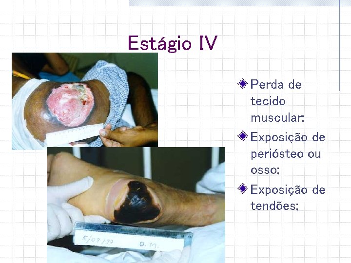 Estágio IV Perda de tecido muscular; Exposição de periósteo ou osso; Exposição de tendões;