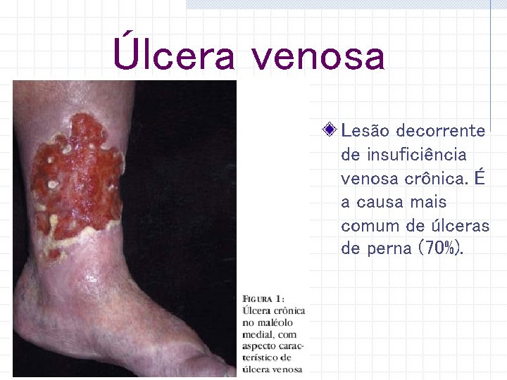 Úlcera venosa Lesão decorrente de insuficiência venosa crônica. É a causa mais comum de