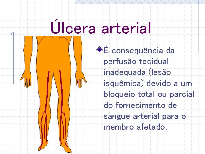 Úlcera arterial É consequência da perfusão tecidual inadequada (lesão isquêmica) devido a um bloqueio