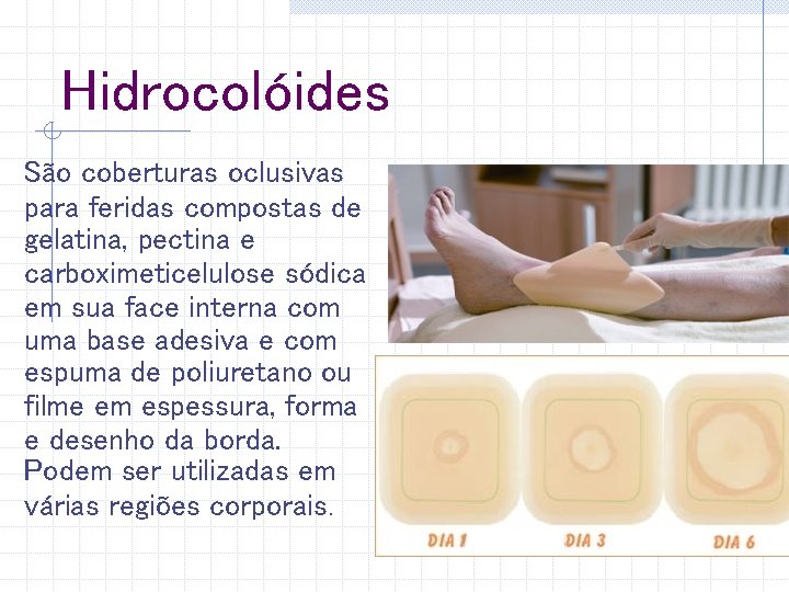 Hidrocolóides São coberturas oclusivas para feridas compostas de gelatina, pectina e carboximeticelulose sódica em