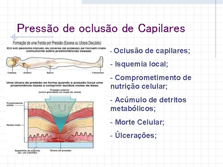 Pressão de oclusão de Capilares - Oclusão de capilares; - Isquemia local; - Comprometimento