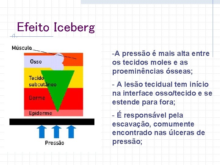 Efeito Iceberg -A pressão é mais alta entre os tecidos moles e as proeminências