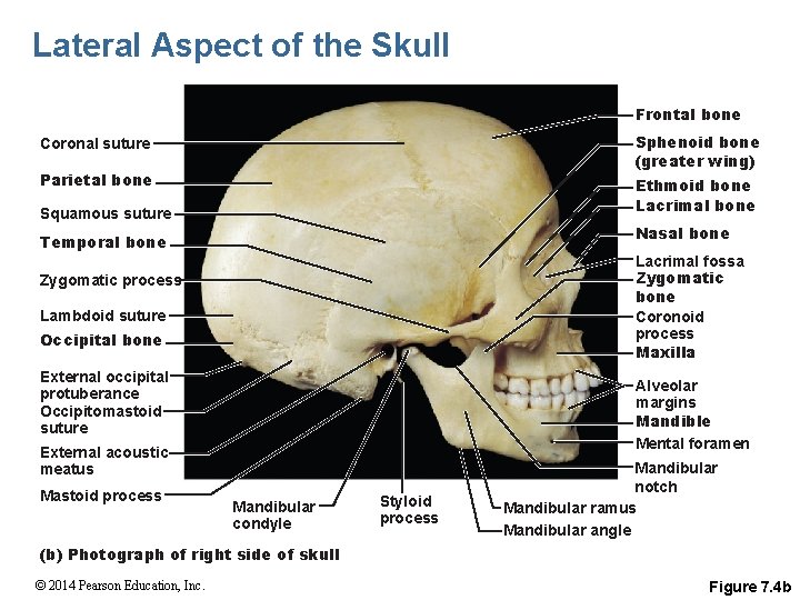 Lateral Aspect of the Skull Frontal bone Sphenoid bone (greater wing) Coronal suture Parietal