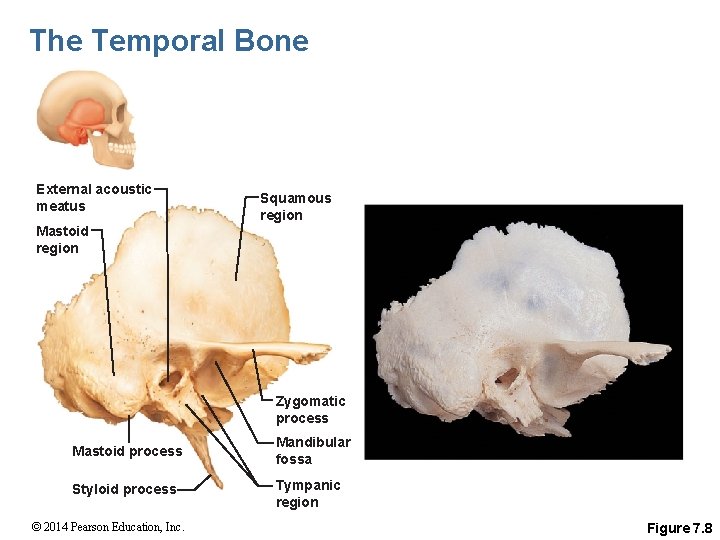 The Temporal Bone External acoustic meatus Squamous region Mastoid region Zygomatic process Mastoid process