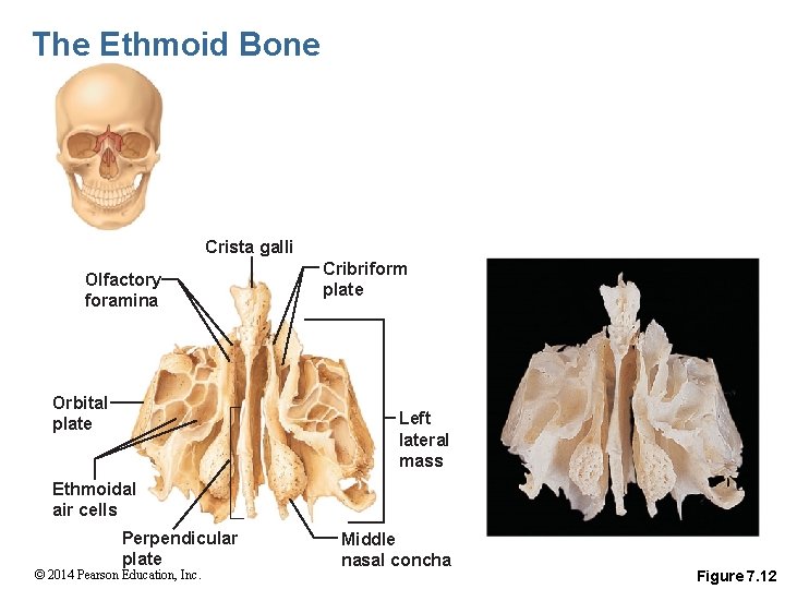 The Ethmoid Bone Crista galli Olfactory foramina Orbital plate Cribriform plate Left lateral mass