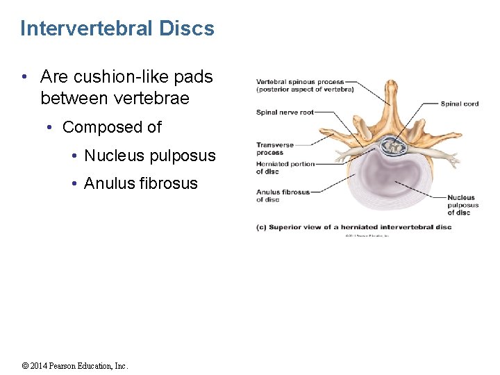 Intervertebral Discs • Are cushion-like pads between vertebrae • Composed of • Nucleus pulposus